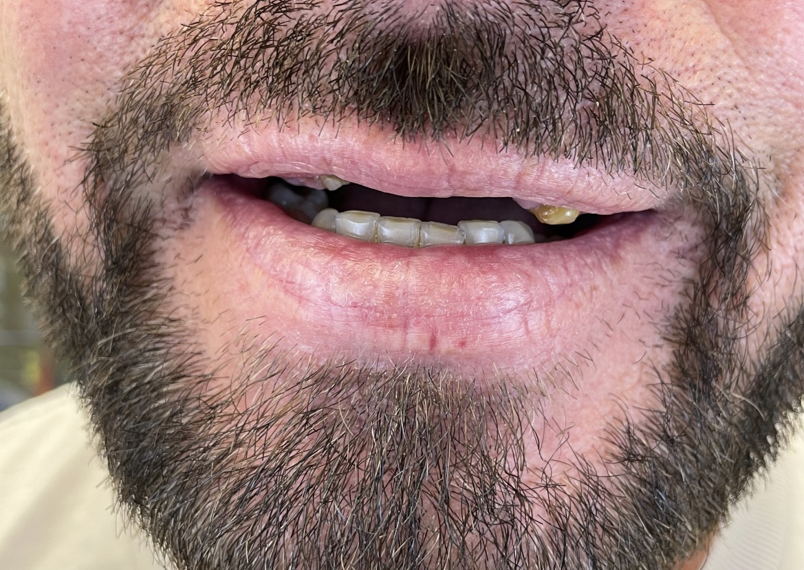 Przed leczeniem - Pełna odbudowa górnego i dolnego łuku na implantach z mostami bez sztucznego dziąsła