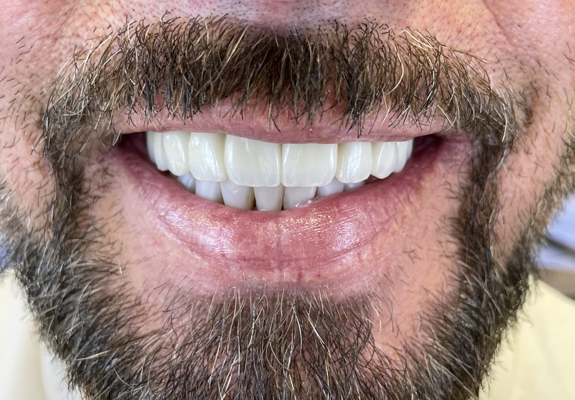 Po leczeniu - Pełna odbudowa górnego i dolnego łuku na implantach z mostami bez sztucznego dziąsła