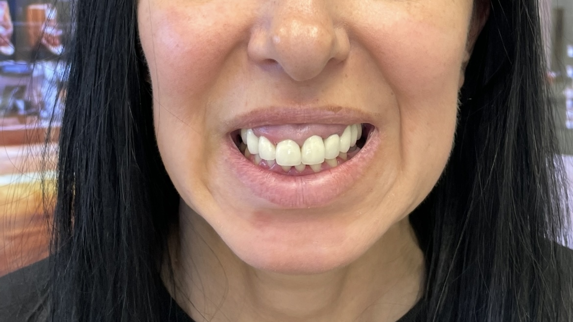 Przed leczeniem - Transformacja uśmiechu z All-on-6