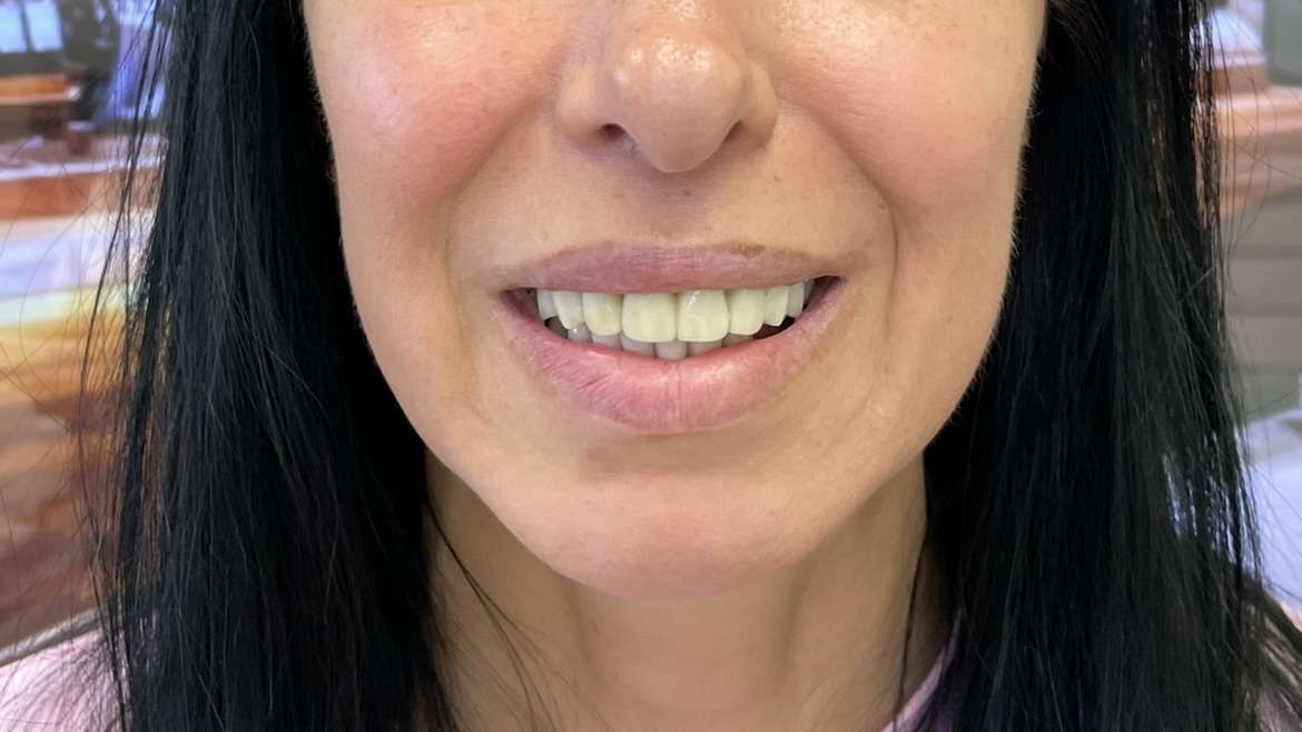 Po leczeniu - Transformacja uśmiechu z All-on-6
