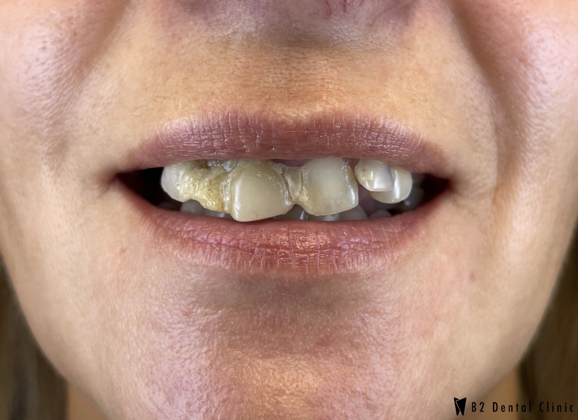 Przed leczeniem - Prawda, że jest już pięknie?