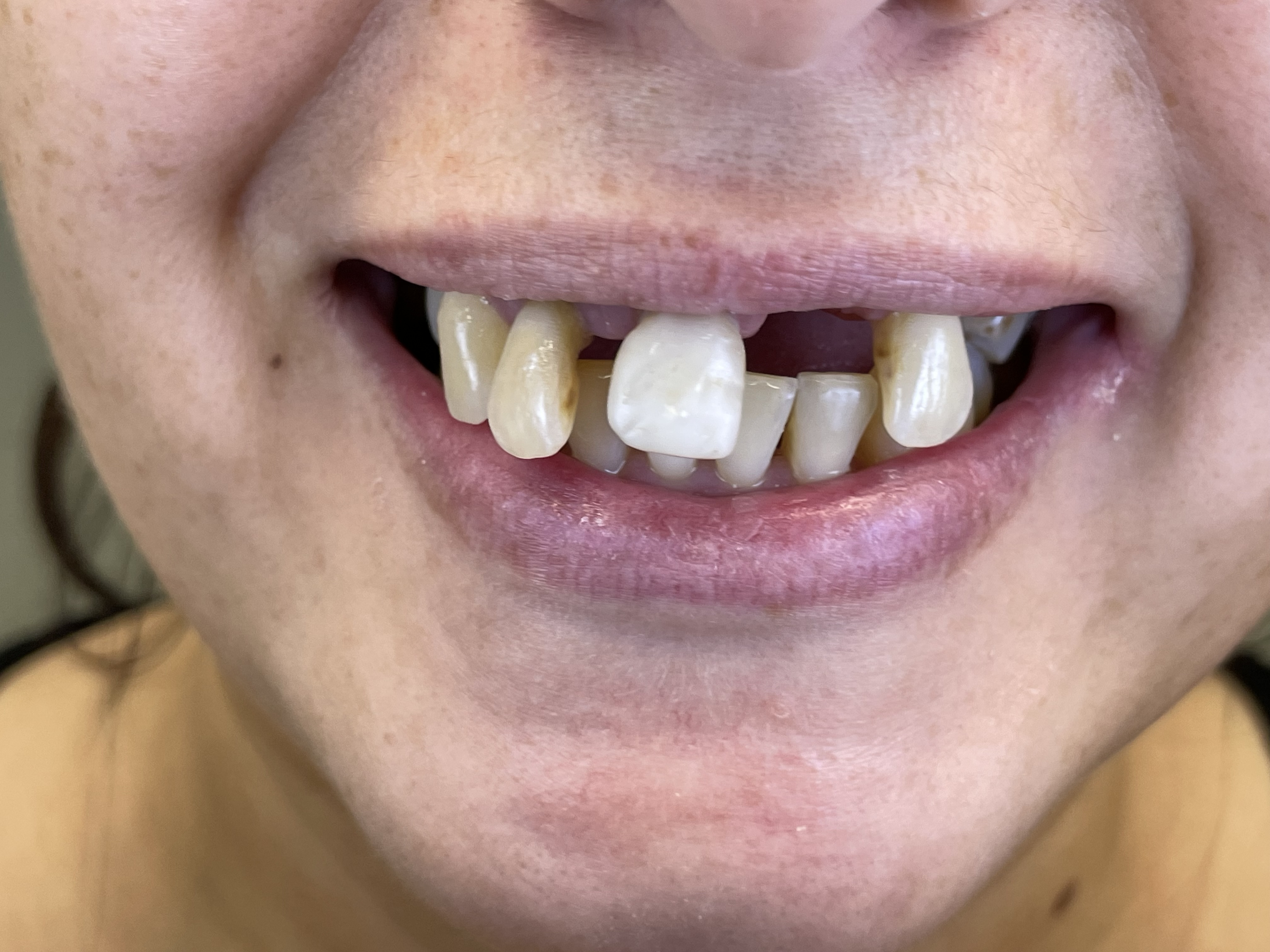 Przed leczeniem - Nowy uśmiech, nowe życie